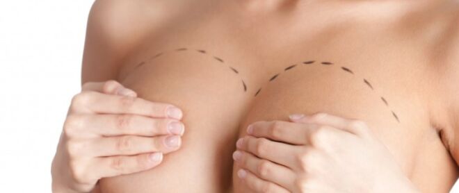 Увеличение груди (Маммопластика): Преимущества и возможности