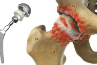 Эндопротезирование тазобедренного сустава: спасение от неподвижности