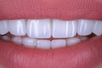 Лучшие виниры для зубов: керамические или композитные?