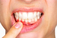 Кровоточивость десен – причины и лечение