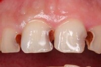 Сколько стоит пломба передних зубов?