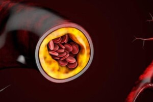Признаки высокого холестерина на коже: как распознать первые симптомы