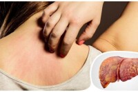 Признаки проблем с печенью: как распознать опасность для здоровья