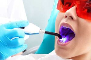 Як забезпечити довговічність фотополімерної пломби: поради стоматологам