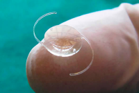 Рефракционная замена хрусталика: Современный подход к лечению нарушений зрения