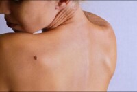 Опухоли кожи, меланома