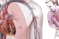 Стенокардия при гипертонии: симптомы и лечение