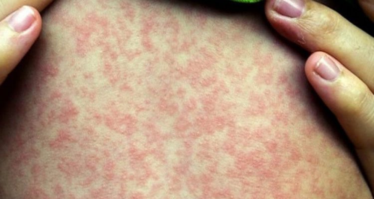 Защита от кори: комплексный подход к здоровью