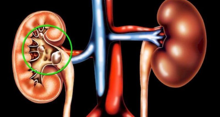 Высокое давление и камни в почках: 8 тревожных симптомов