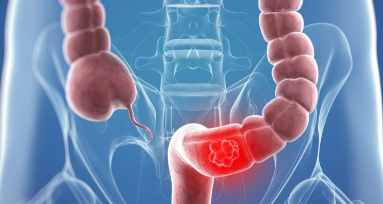 Как обнаружить рак на ранней стадии: советы эксперта