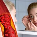 Холестерин и ваше зрение: как повышенное давление влияет на глаза