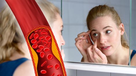 Холестерин и ваше зрение: как повышенное давление влияет на глаза