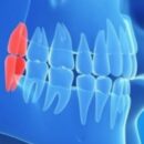 Зубы мудрости: когда удаление необходимо для вашего здоровья