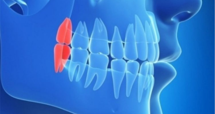 Зубы мудрости: когда удаление необходимо для вашего здоровья