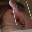 Применение иглоукалывания для снятия болей при артрите, остеохондрозе, болях в спине