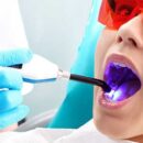 Як забезпечити довговічність фотополімерної пломби: поради стоматологам