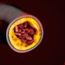 Признаки высокого холестерина на коже: как распознать первые симптомы