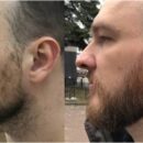 Пересадка бороды: технологии, этапы, реабилитация и результаты